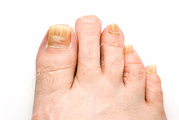 Toenail fungus treatment and restoration in the Wayne County, MI: Detroit (Hamtramck, River Rouge, Dearborn, Melvindale, Highland Park, Grosse Pointe Park, Grosse Pointe, Lincoln Park, Allen Park, Redford Charter Twp)